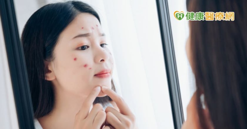 從痘痘看健康　戰痘妙招大公開