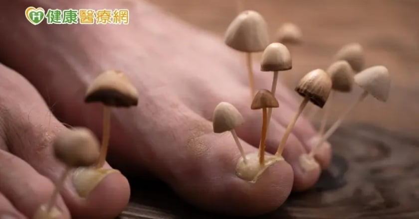 夏日危肌/國人指甲3大常見病症 灰指甲mix香港腳「黴完黴了」