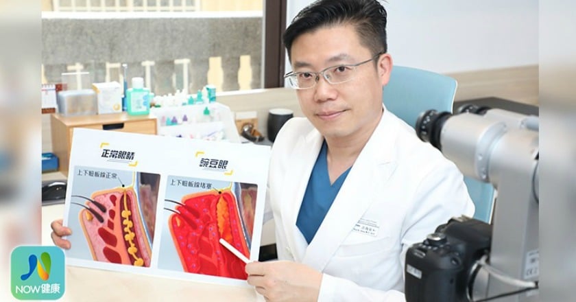 豌豆眼是缺油型乾眼症高風險群 優化脈衝光深層緩解