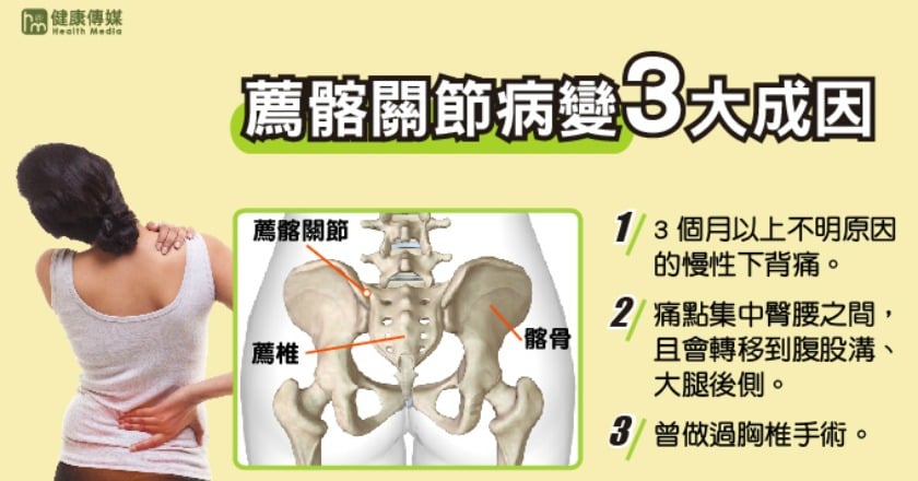 婦人下背痛逾半年 確診揪出薦髂關節病變