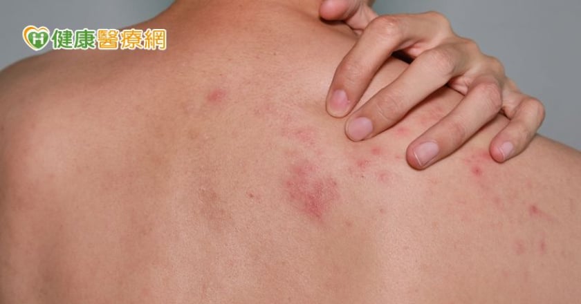 5旬男吃感冒藥皮膚剝落糜爛 禍首竟是兩週前服用的藥物