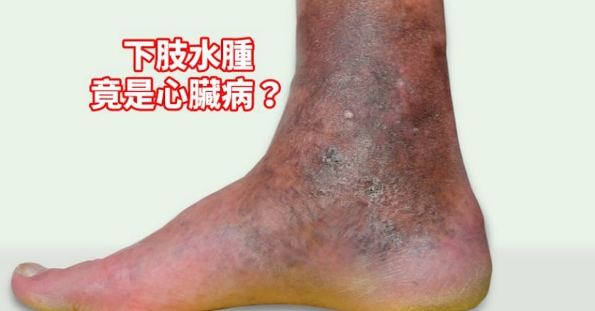 老翁喘、下肢水腫、靜脈曲張...沒想到竟是心臟病？