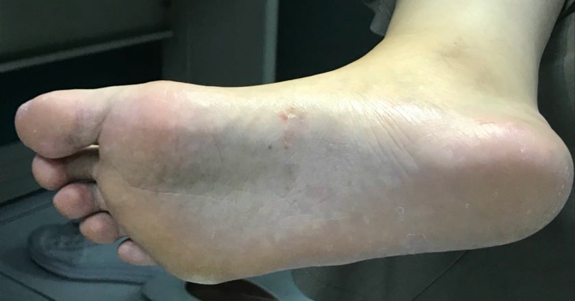 換季汗皰疹發作 她雙腳指縫長滿水泡奇癢無比