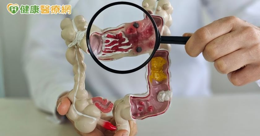 大腸癌年輕化！ 台大研究證實：「提早10年篩檢」發生、死亡率雙雙下降