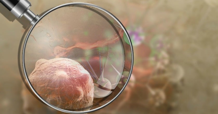 藝人賀一航大腸癌病逝 醫師指出癌友3大迷思