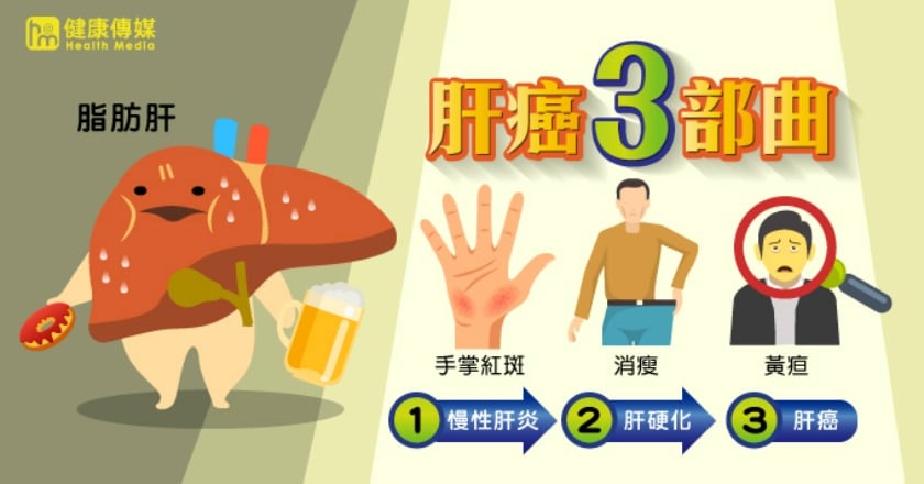 逾半國人有脂肪肝 肝癌三部曲恐步步逼近