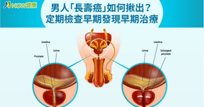 男人「長壽癌」如何揪出？ 定期檢查早期發現早期治療