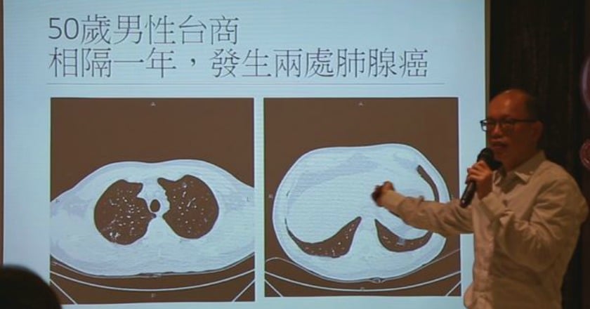 肺癌再發率高　雙癌、三癌屢見不鮮