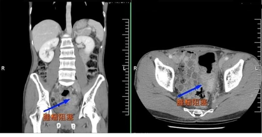 大腸癌年輕化 腹脹血便是徵兆