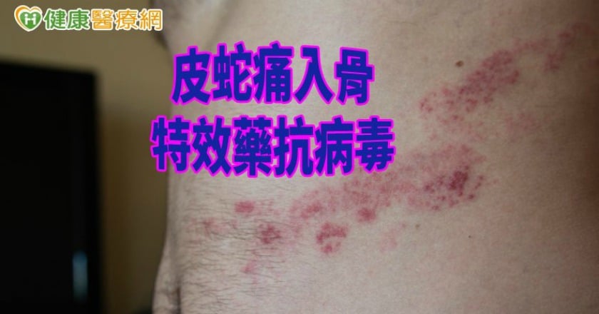 皮蛇痛入骨！　這年齡罹患風險超高