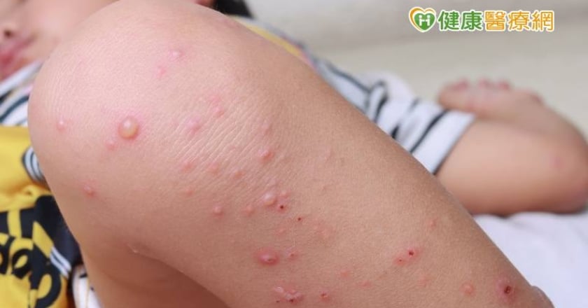 感染腸病毒無特效藥！　警惕「四大重症前兆」速就醫