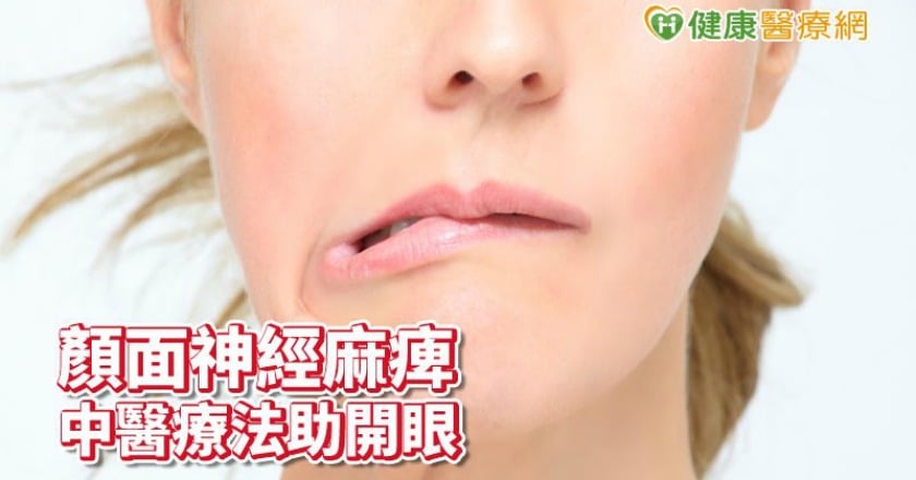 顏面神經麻痺右眼睜不開 針灸助婦人開眼