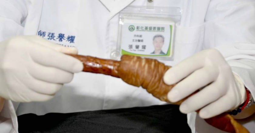 誤認腸躁症! 男大生「大腸包小腸」進開刀房