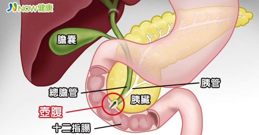 罕見壺腹癌難確診 家族性腺性息肉患者屬高危險群