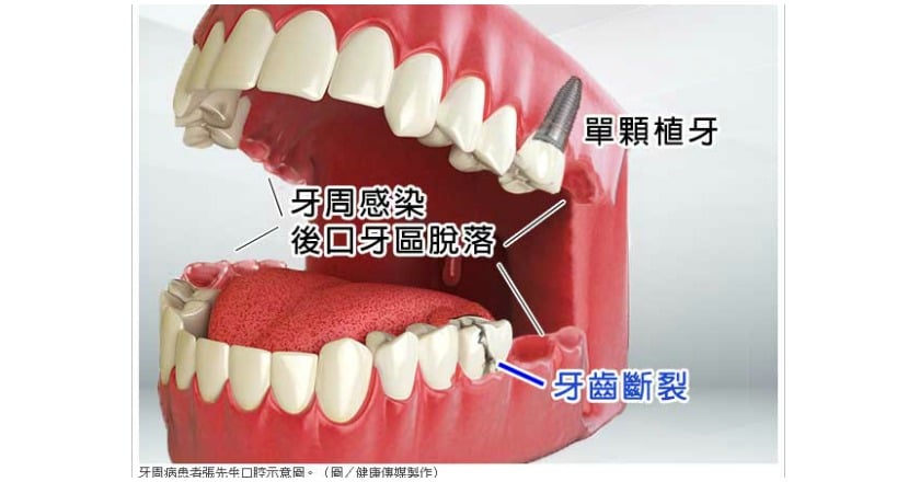 牙齒各司其職缺一不可 植牙不讓好牙應聲倒
