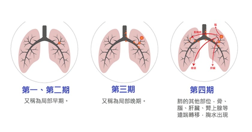 肺癌「新國病」 逾半患者確診時已第3、4期