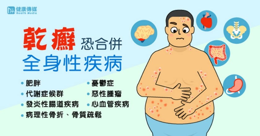 乾癬併發症知多少? 林明秀醫師談治療面面觀