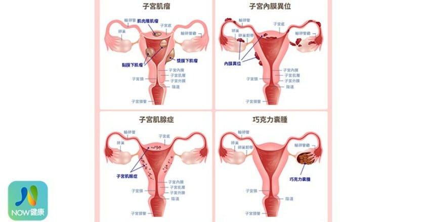常見婦科疾病有哪些? 婦科醫師1張圖說明白