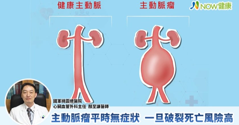 寒流來襲小心「沉默炸彈」腹主動脈瘤一旦破裂恐致死