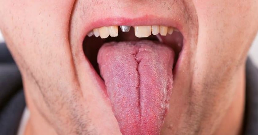 當「墓碑牙」出現 你離缺牙不遠了!