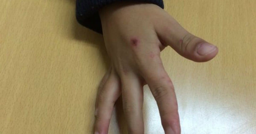 腸胃炎和腸病毒分不清 病症治療皆不同