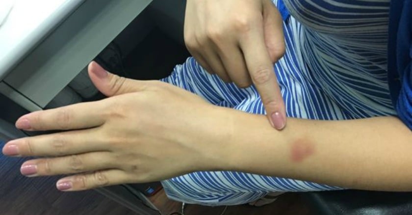 身上常有莫名瘀青? 小心紫斑症上身!