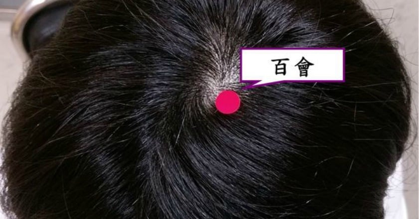 天天失眠加速落髮　針灸治療改善