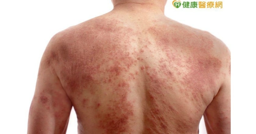 長期罹患乾癬恐併發關節炎 及早治療為關鍵