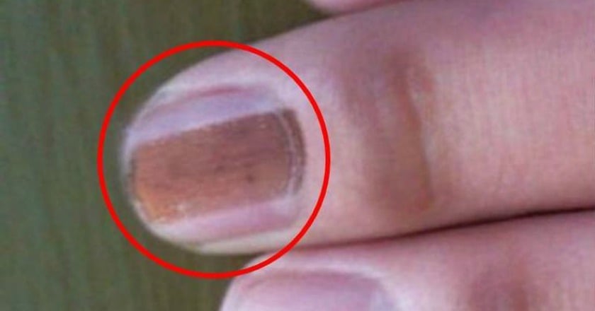 指甲裡長痣 是黑甲症還是皮膚癌?