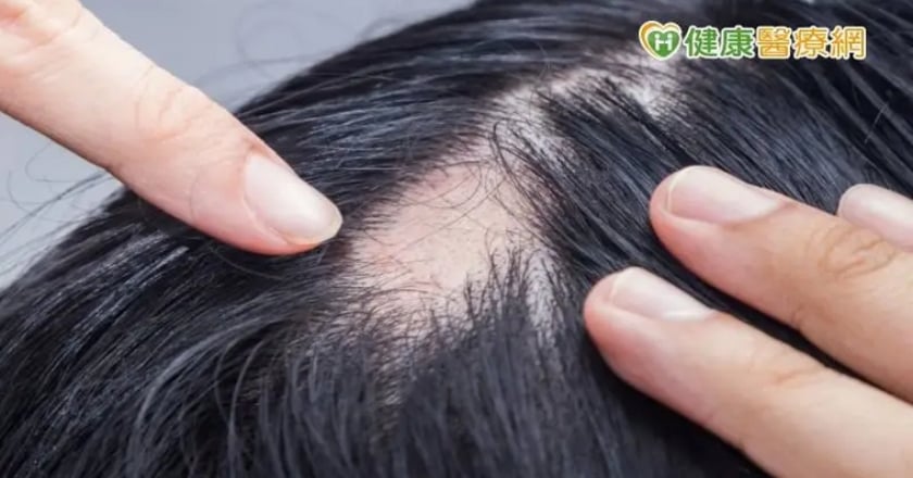 輕熟女竟「禿了」！自信全無陷焦慮　醫揭病因