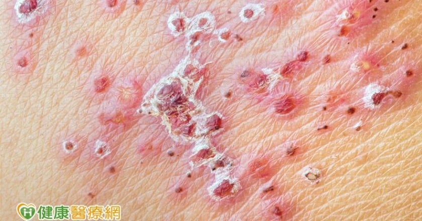 皮蛇纏身　民俗療法醜一生？！