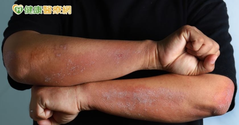 濕疹飲食禁忌多，誤食更癢更難受？ 中醫師利濕止癢處方大公開
