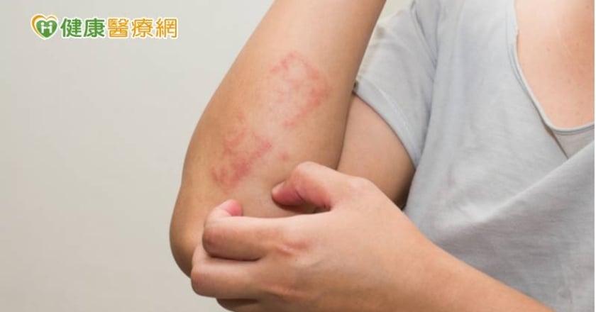 新冠疫苗引皮膚過敏？　醫：診治後可有效改善