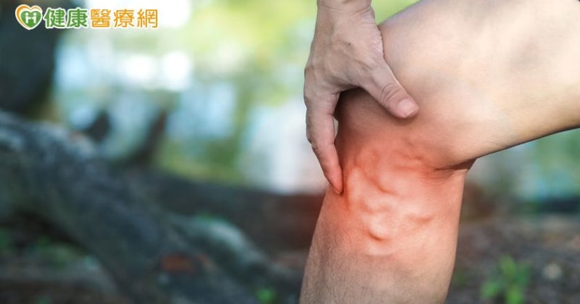 靜脈曲張治療怎麼選？醫解析「最新微創技術」 高齡族群也適合
