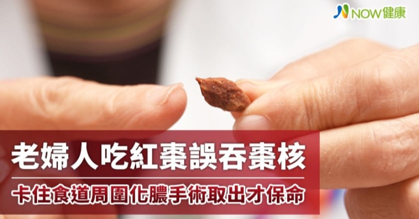 老婦吃紅棗誤吞棗核 卡住食道周圍化膿手術取出才保命