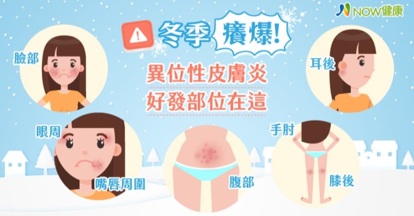 異位性皮膚炎盛行於冬季 尤其這幾個部位特別容易發作