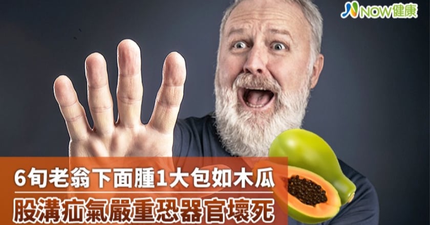 6旬老翁下面腫1大包如木瓜 股溝疝氣嚴重恐器官壞死