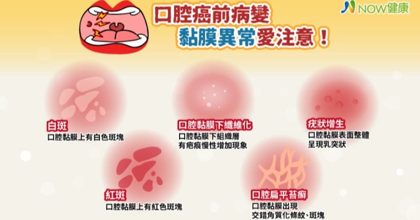 你是口腔癌高危險群嗎？ 口腔癌前病變黏膜異常愛注意