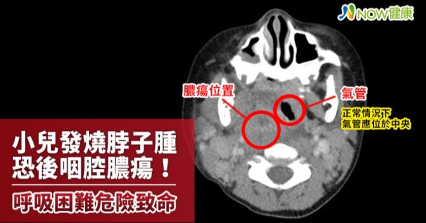 小兒發燒脖子腫恐後咽腔膿瘍 一旦呼吸困難危險致命！
