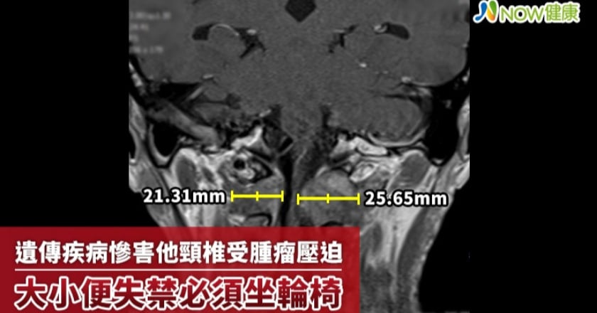 遺傳疾病慘害他頸椎受腫瘤壓迫 大小便失禁必須坐輪椅