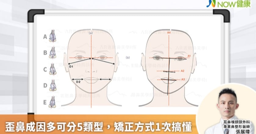 小金城武被翻出歪鼻舊照 歪鼻成因多矯正方式1次搞懂