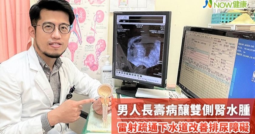 男人長壽病釀雙側腎水腫 雷射疏通下水道改善排尿障礙