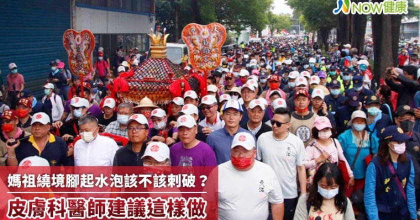 媽祖遶境腳起水泡該不該刺破？ 皮膚科醫師建議這樣做