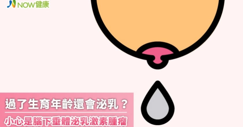 過了生育年齡還會泌乳？ 小心是腦下垂體泌乳激素腫瘤