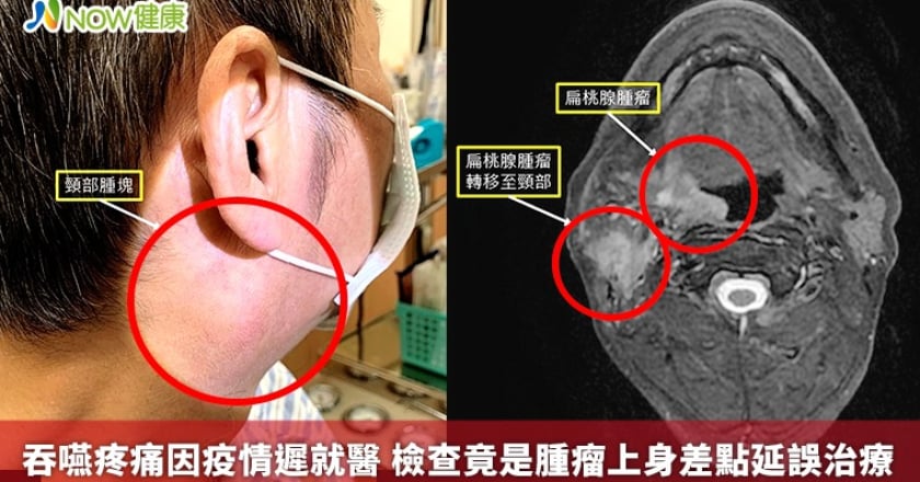 吞嚥疼痛因疫情遲就醫 檢查竟是腫瘤上身差點延誤治療