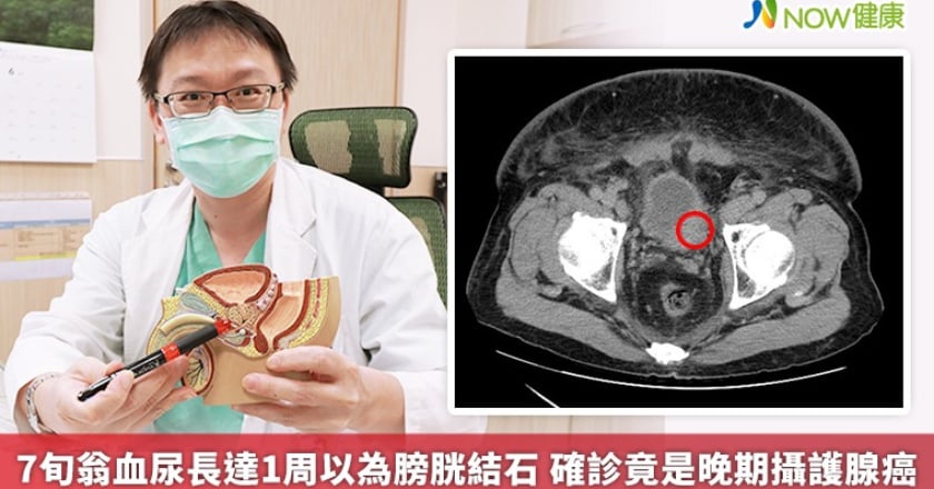 7旬翁血尿長達1周以為膀胱結石 確診竟是晚期攝護腺癌