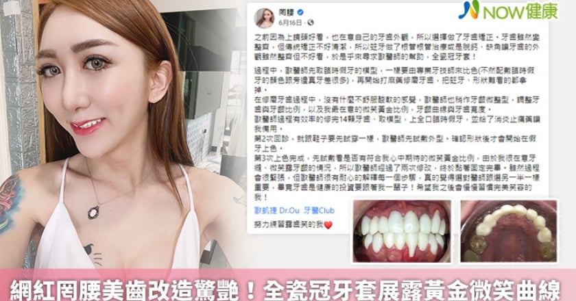 網紅罔腰美齒改造驚艷! 全瓷冠牙套展露黃金微笑曲線