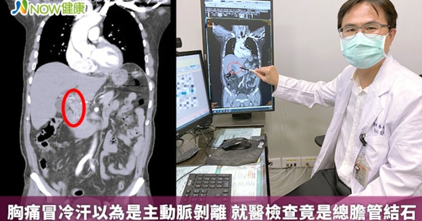 胸痛冒冷汗以為是主動脈剝離 就醫檢查竟是總膽管結石