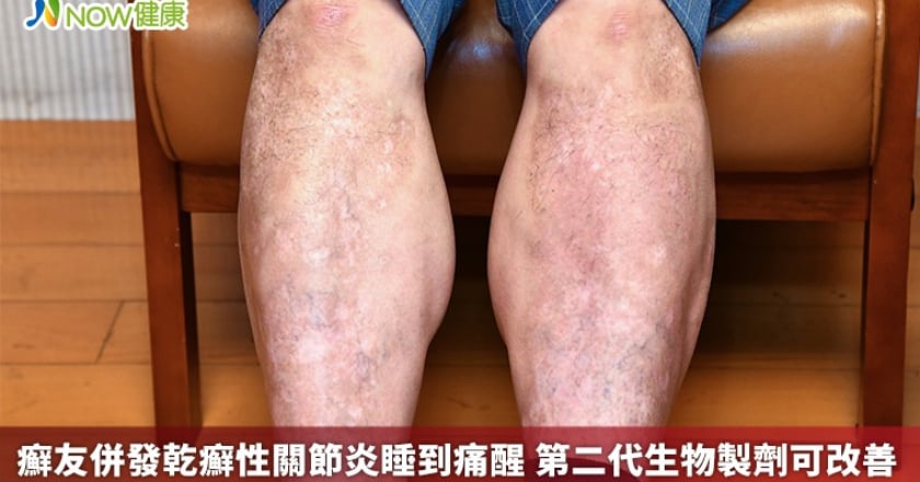 癬友併發乾癬性關節炎睡到痛醒 第二代生物製劑可改善