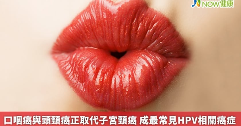 口咽癌與頭頸癌正取代子宮頸癌 成最常見HPV相關癌症